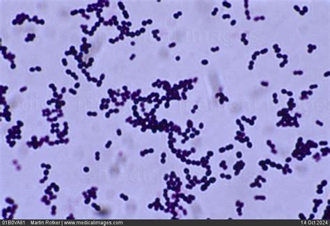 beta-hemolytic streptococcus|Strep throat .